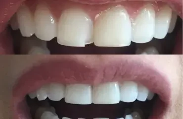 Dental Bonding