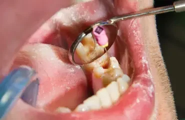 Root Canal Therapy