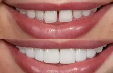 Veneers